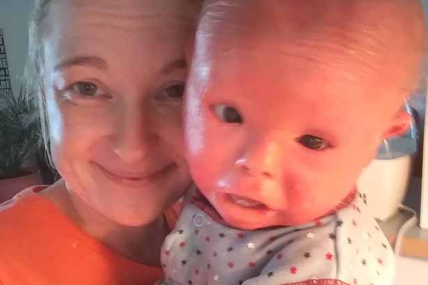 好heal 美國斑色魚鱗癬嬰兒每周浸洗漂白水防感染 Now 新聞