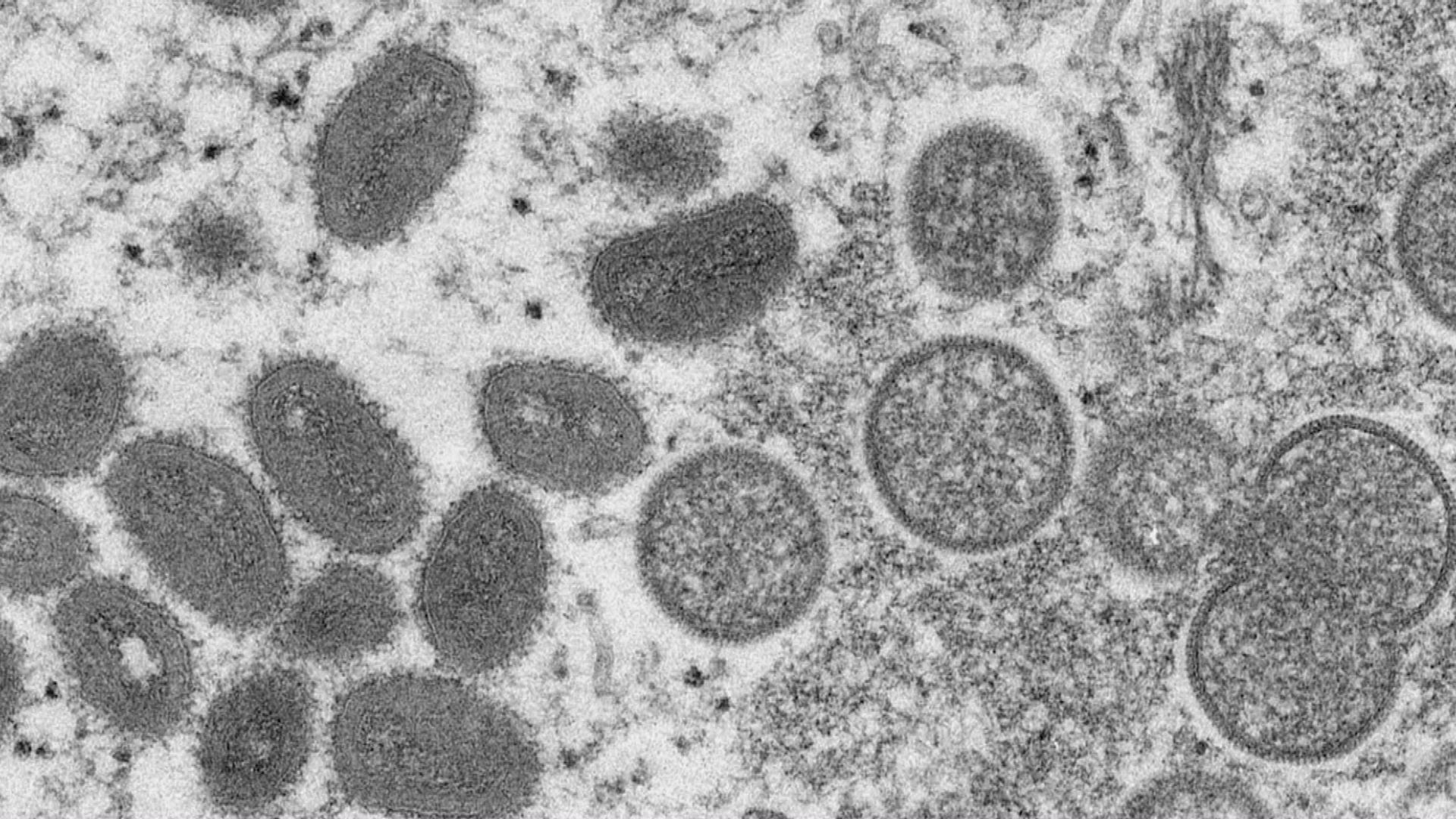 猴痘蔓延至27個非流行國家　世衛認為對全球風險仍屬中等