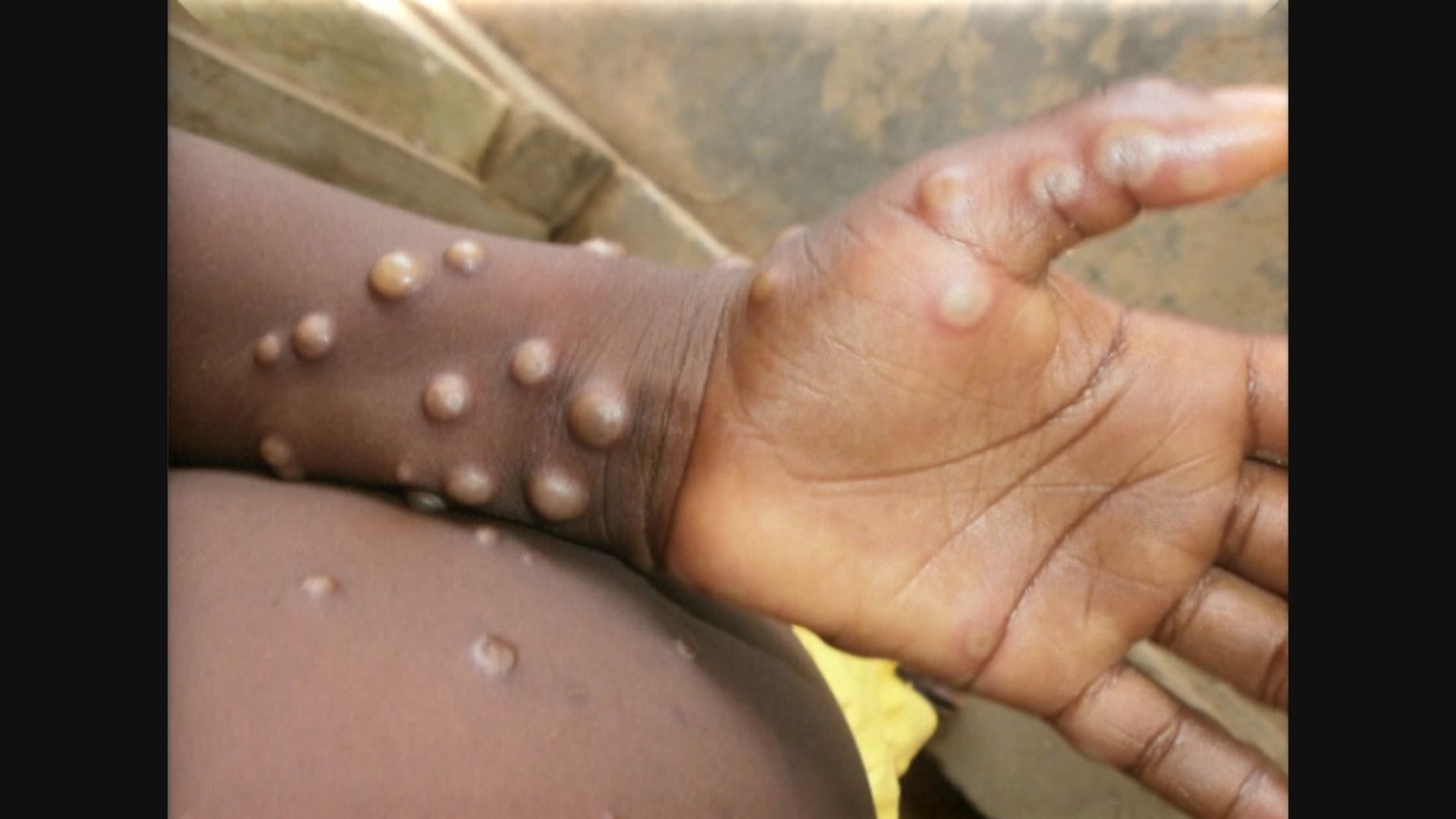 內地發布猴痘診療指南　稱病毒可通過飛沫傳播