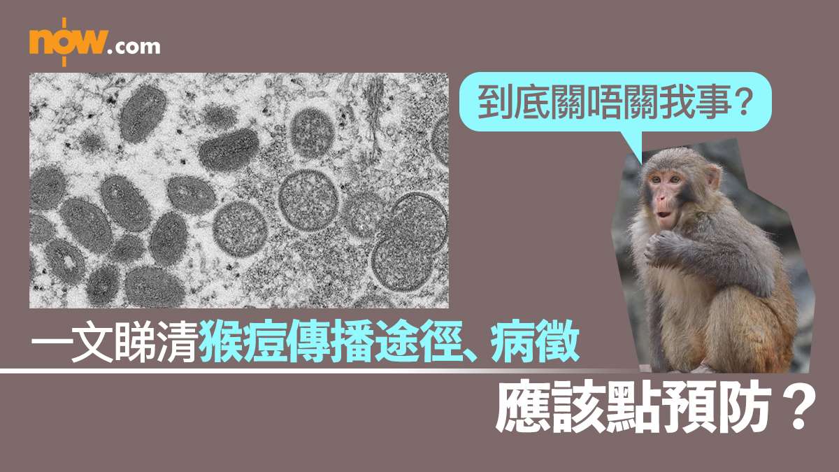 【再錄一宗】一文睇清猴痘傳播途徑、病徵　應該點預防？