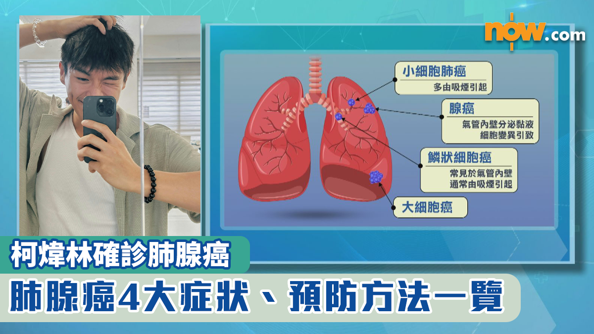 柯煒林確診肺腺癌｜肺腺癌4大症狀、預防方法一覽　非吸煙者確診個案上升