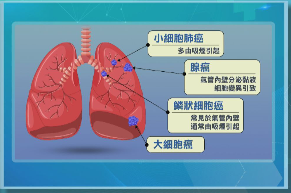 柯煒林確診肺腺癌｜肺腺癌4大症狀、預防方法一覽　非吸煙者確診個案上升