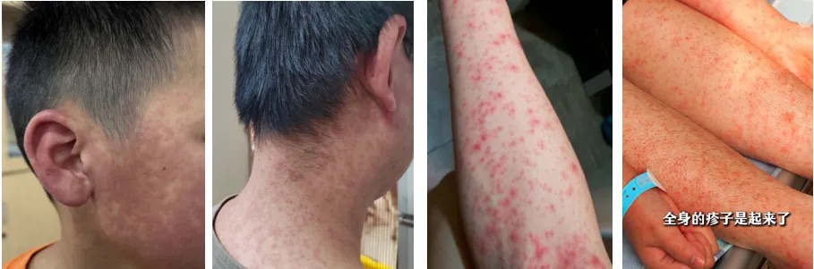 傳染病｜拆解基孔肯雅熱　7大感染徵狀+高危人士