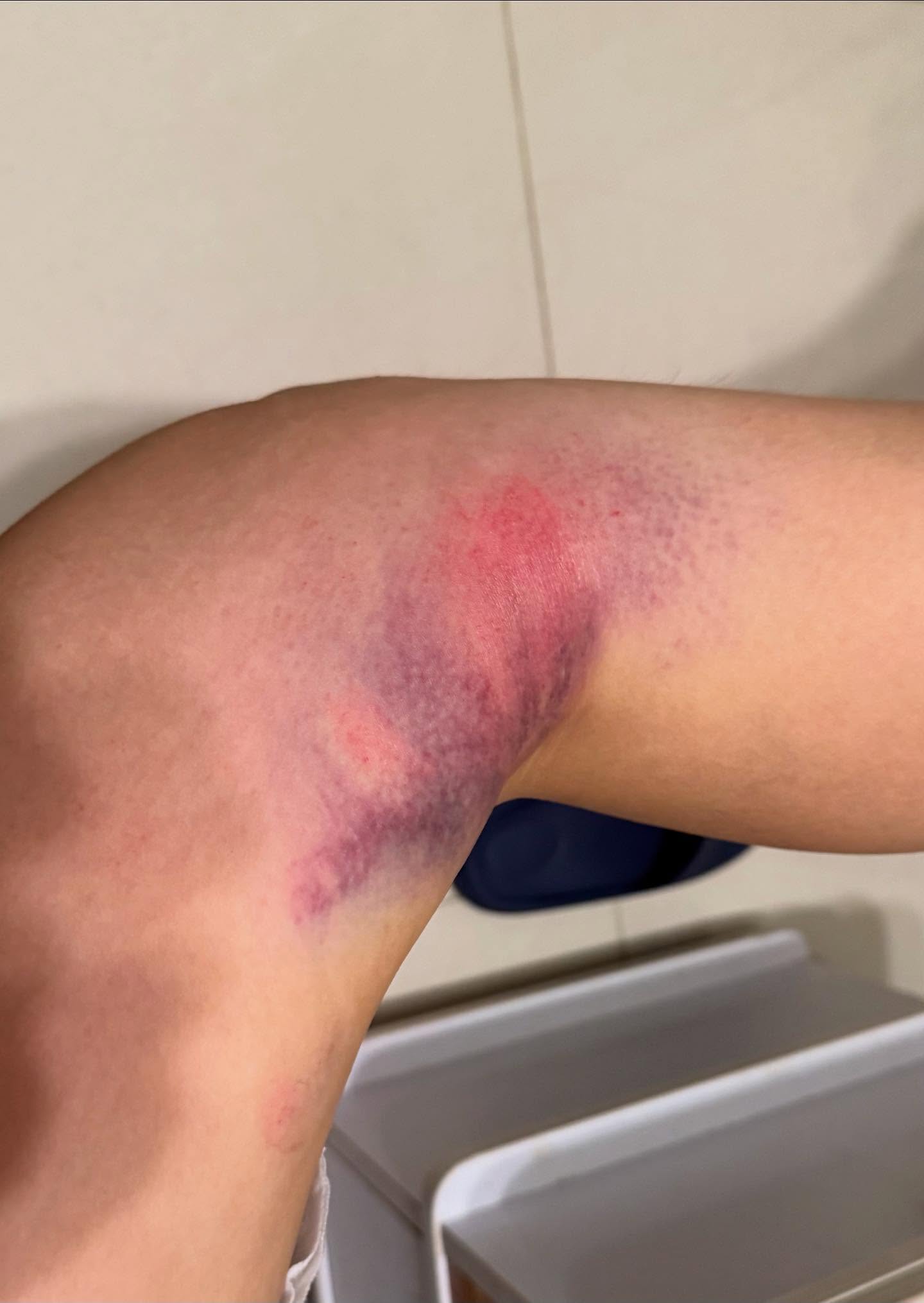 事主膝頭內側亦腫起一大片。