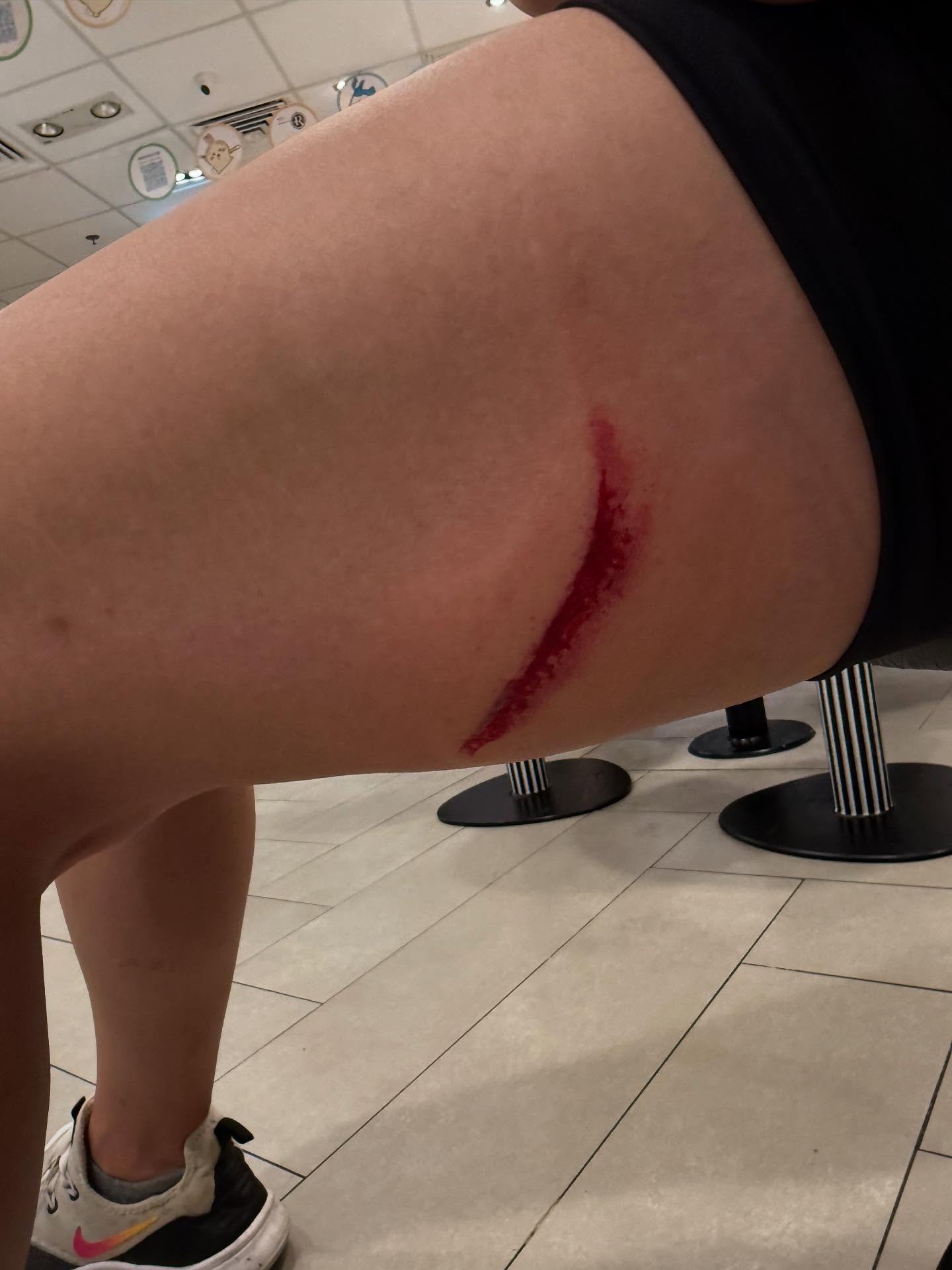 事主大腿遭割傷,留下一條長長的血痕。