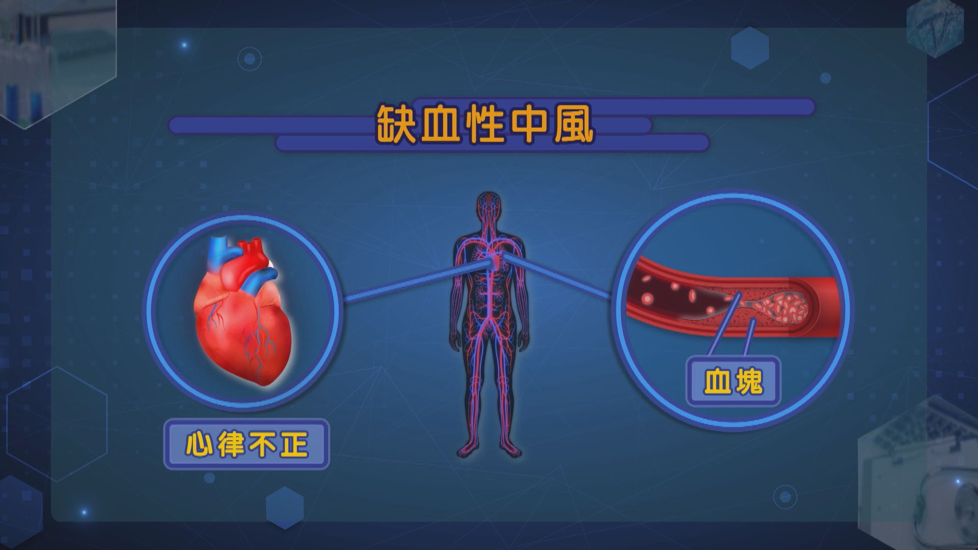 【杏林在線】提防中風