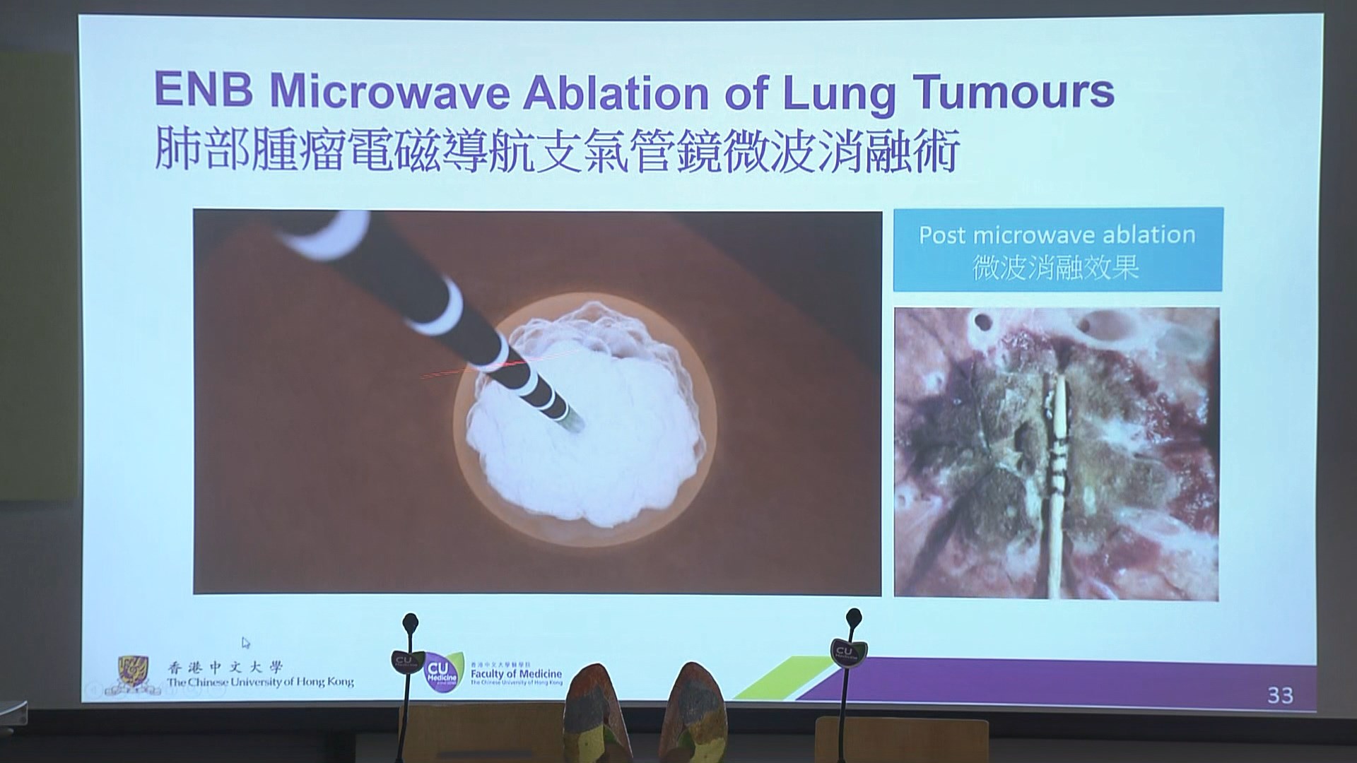 中大引入經氣管微波消融術治療肺癌