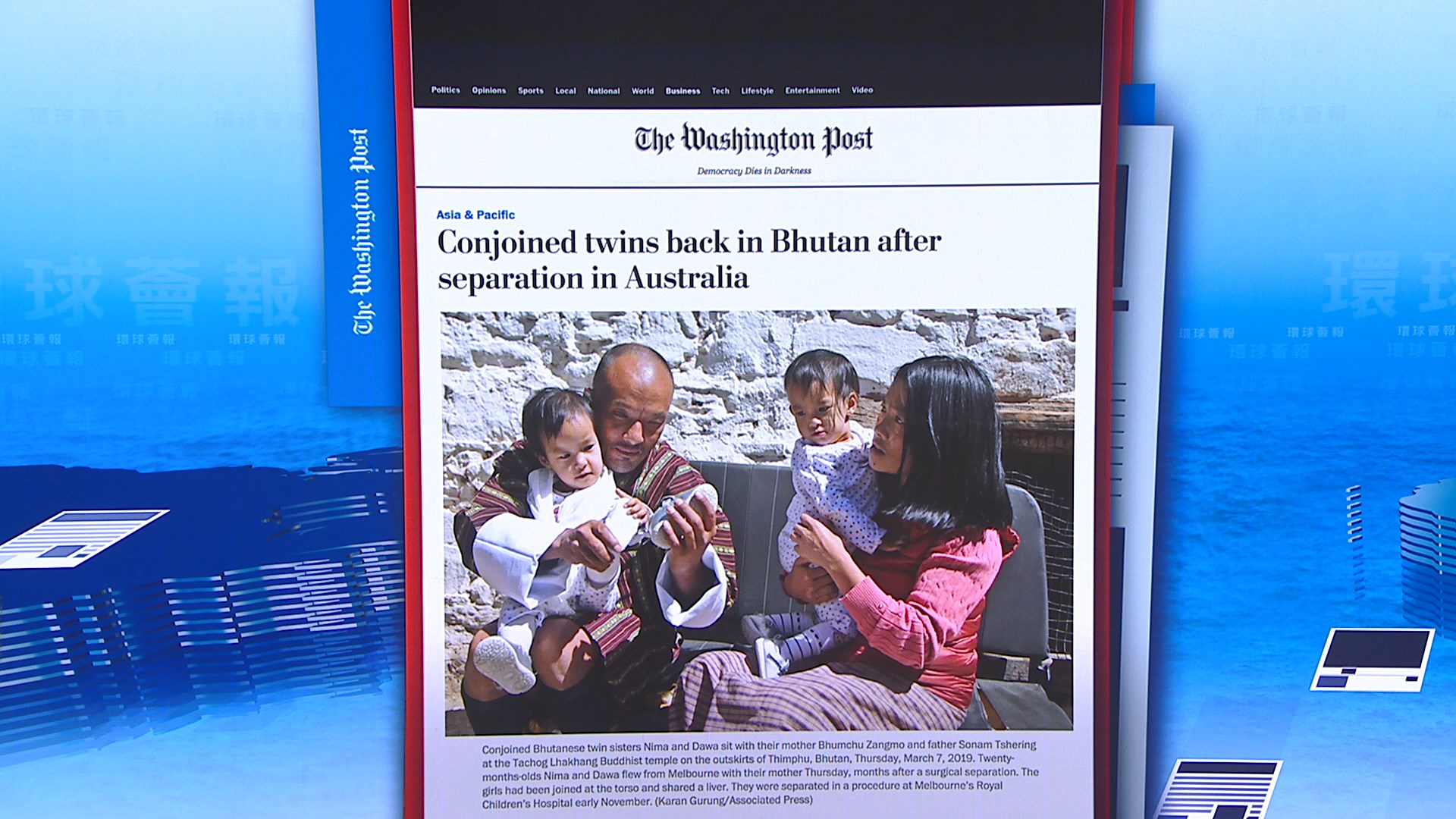 【環球薈報】不丹連體嬰接受分割手術康復返國