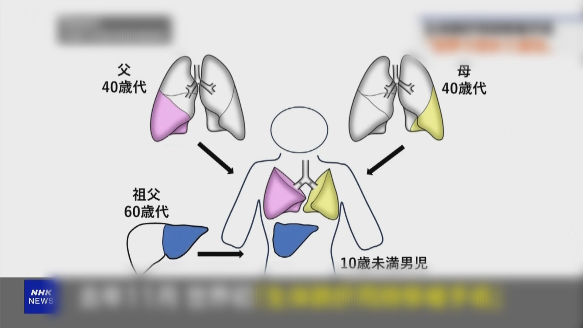 日本男童接受肺及肝部活體同時移植手術 屬全球首例