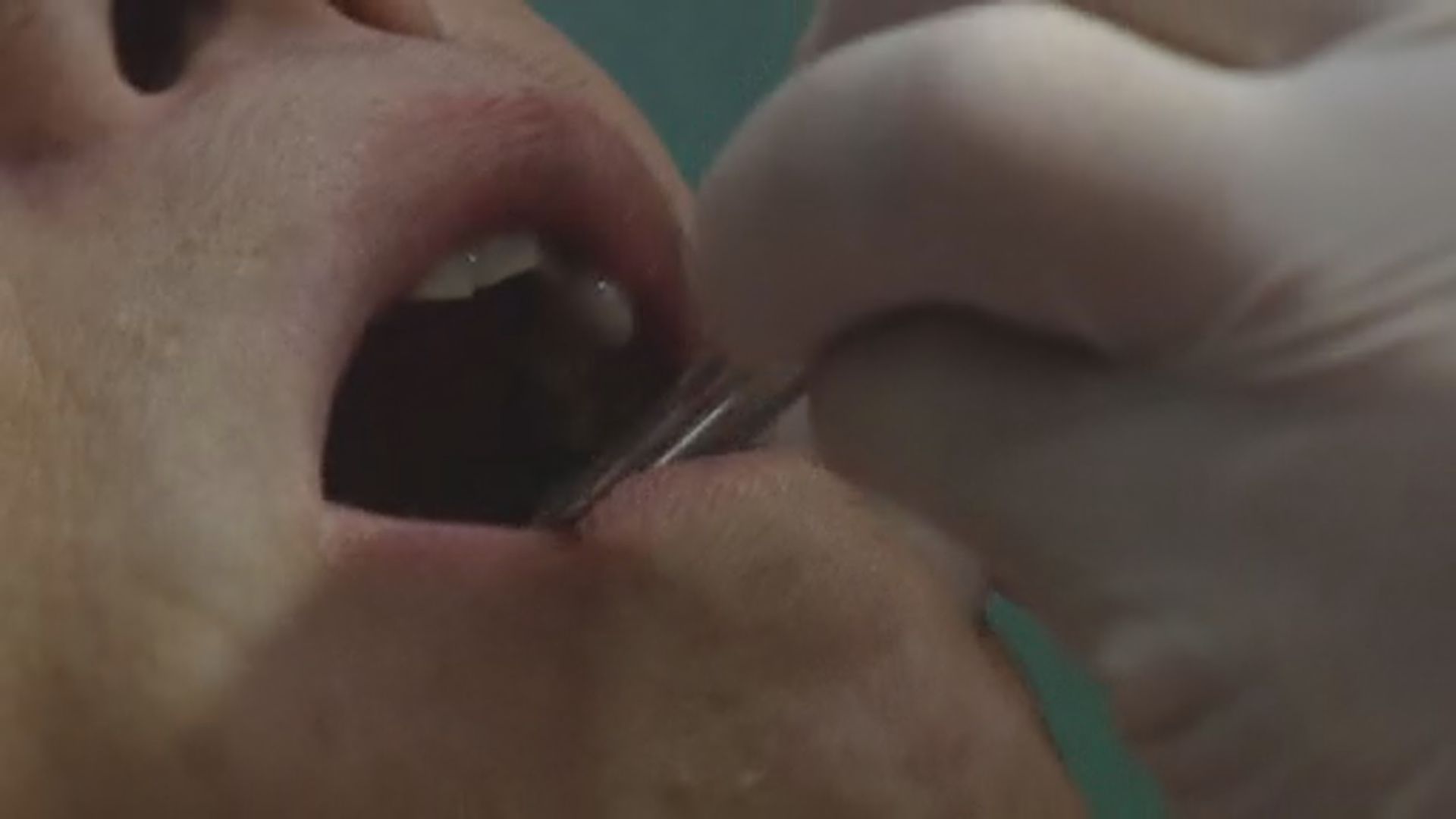 消委會指牙科服務質素參差　有人戴訂造假牙致口腔受損