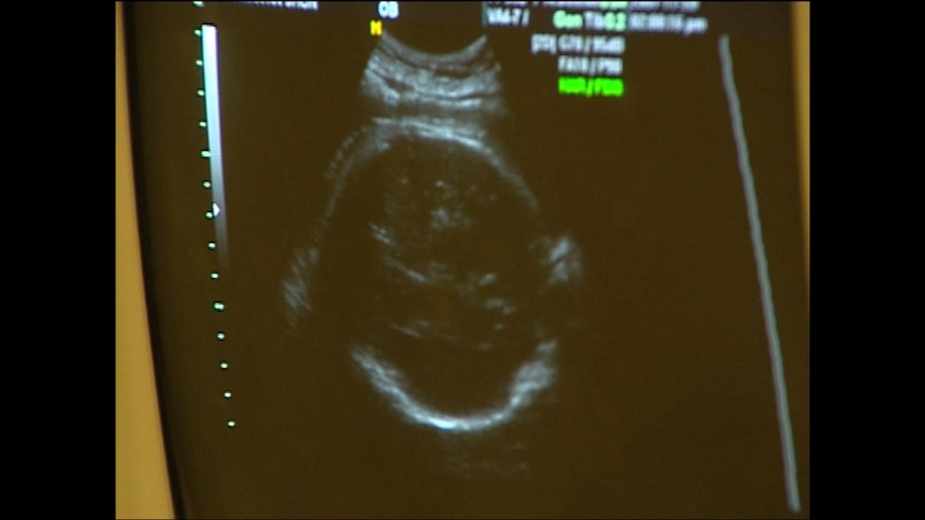 英擬讓孕婦捐贈嚴重缺陷嬰兒器官